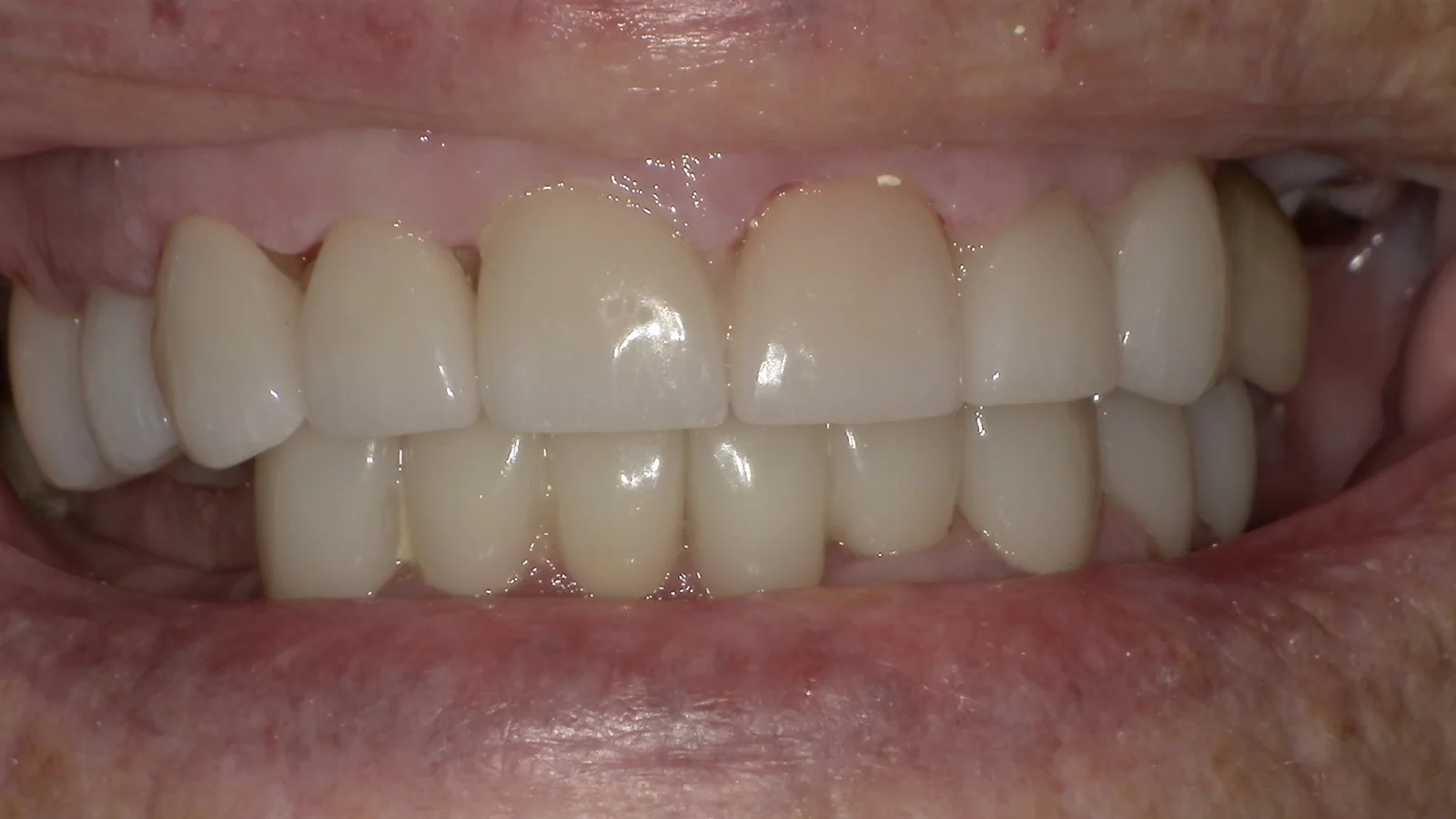 After treatment