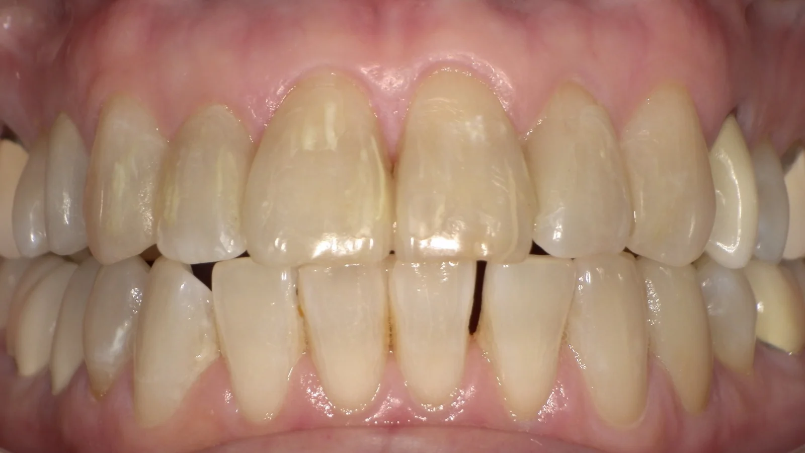 After treatment