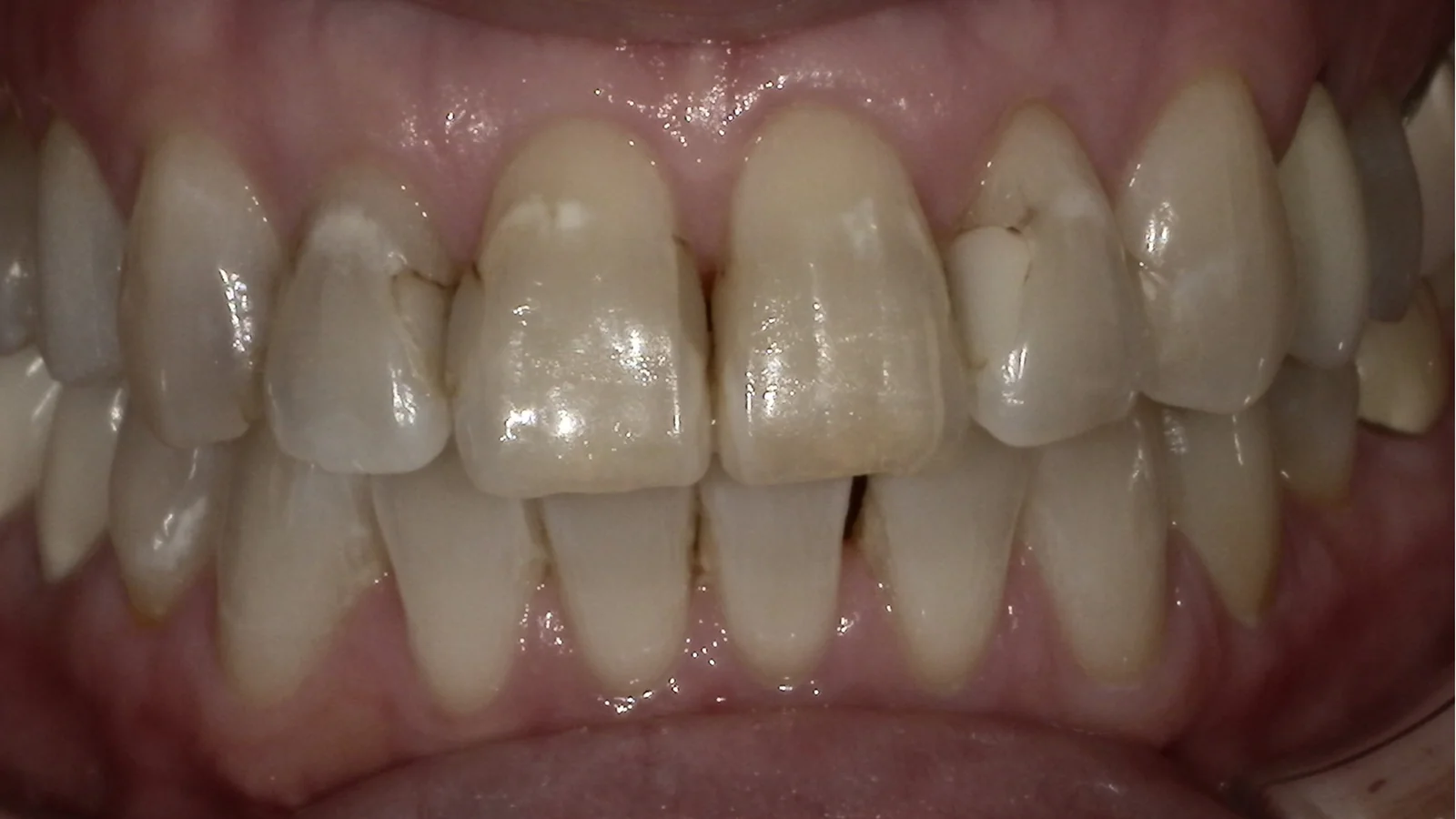 Before treatment