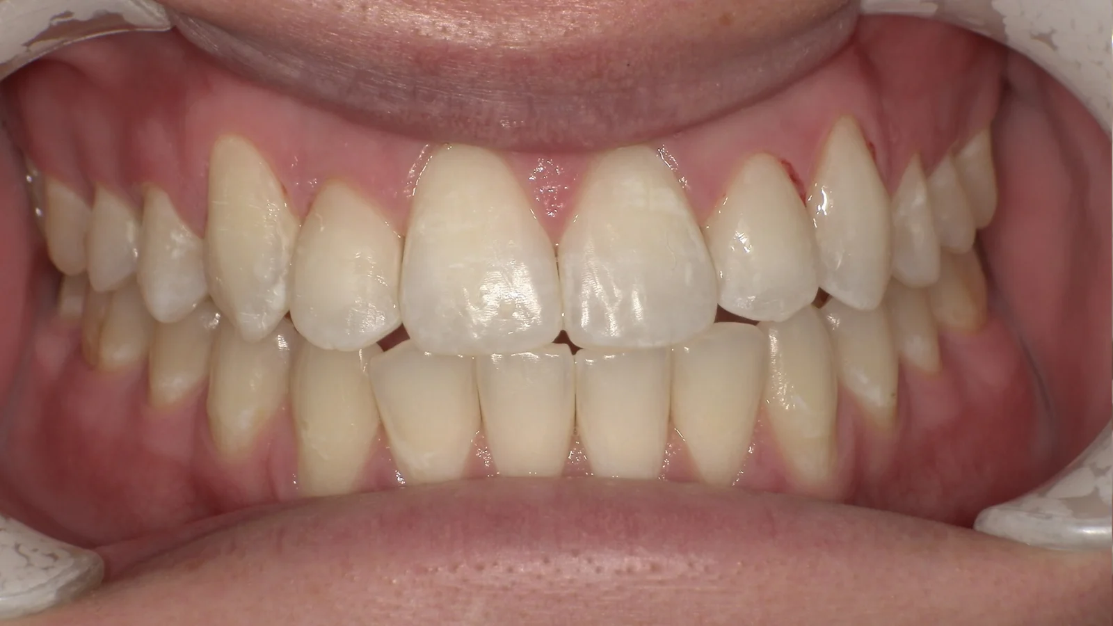 After treatment