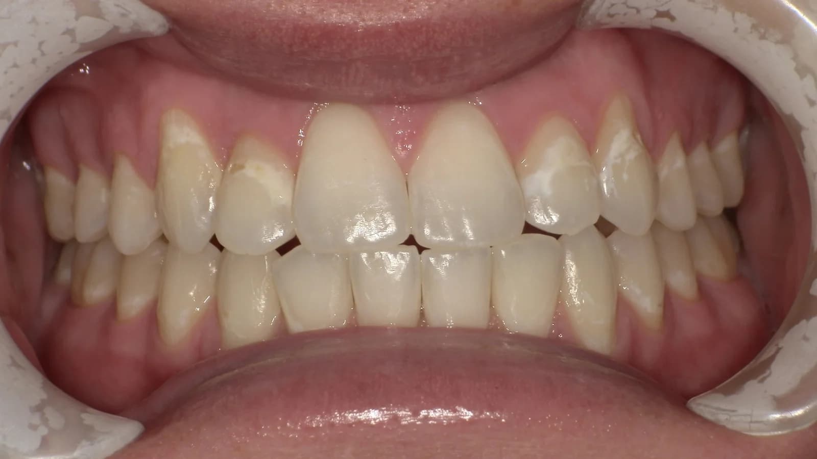 Before treatment