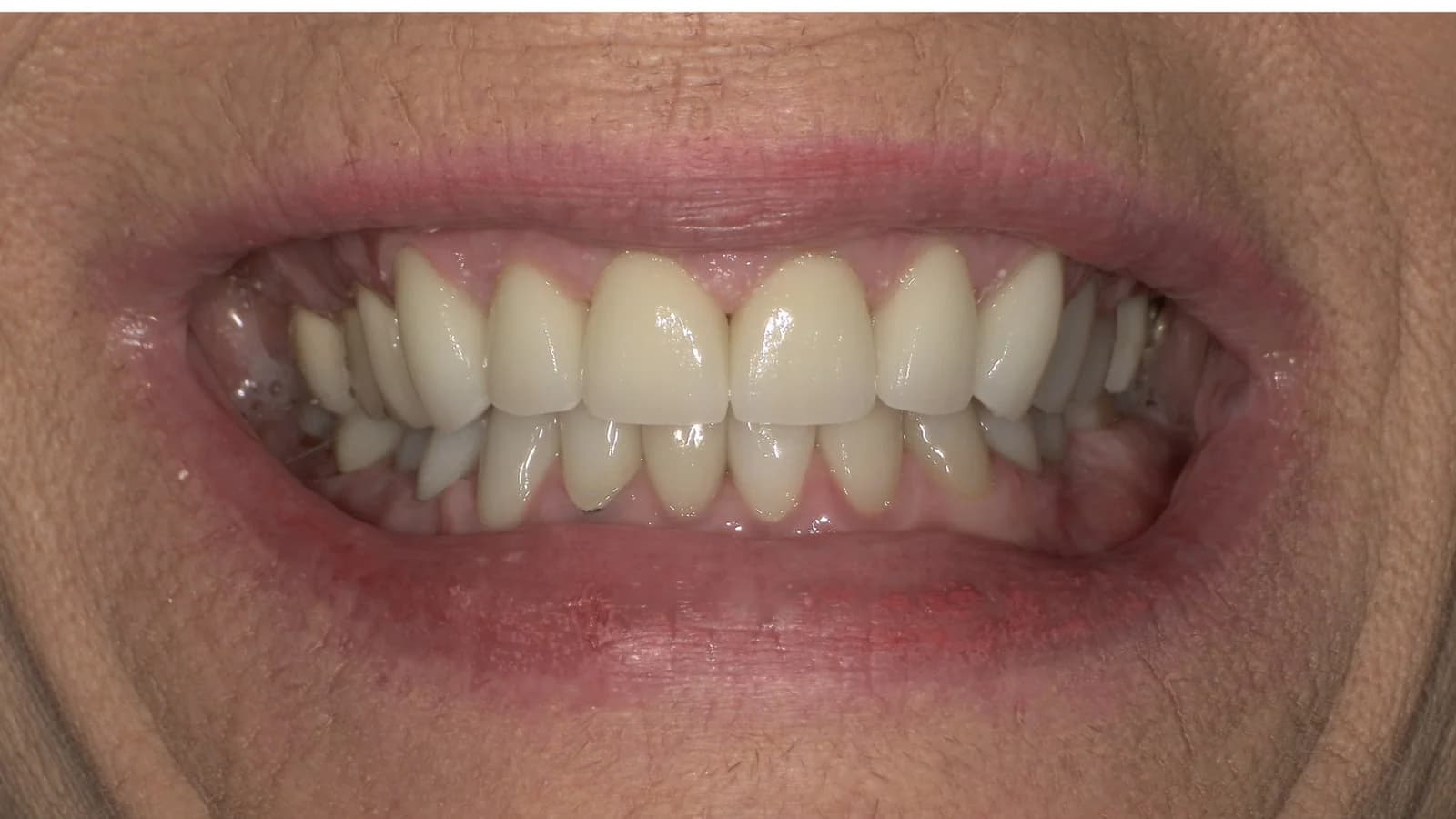 After treatment