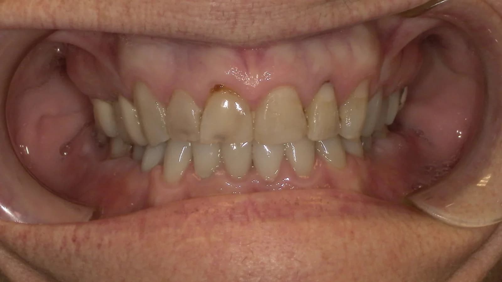 Before treatment