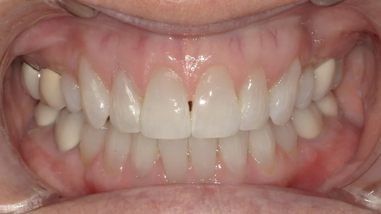 After treatment