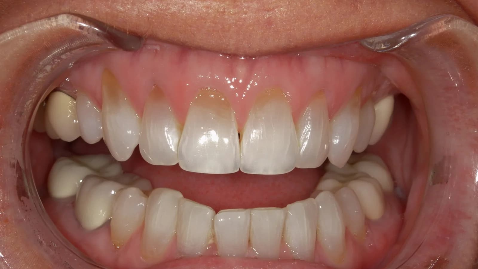 Before treatment