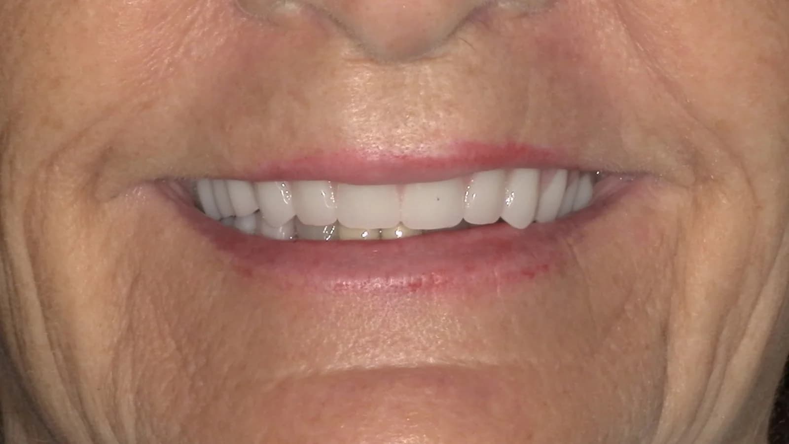 After treatment
