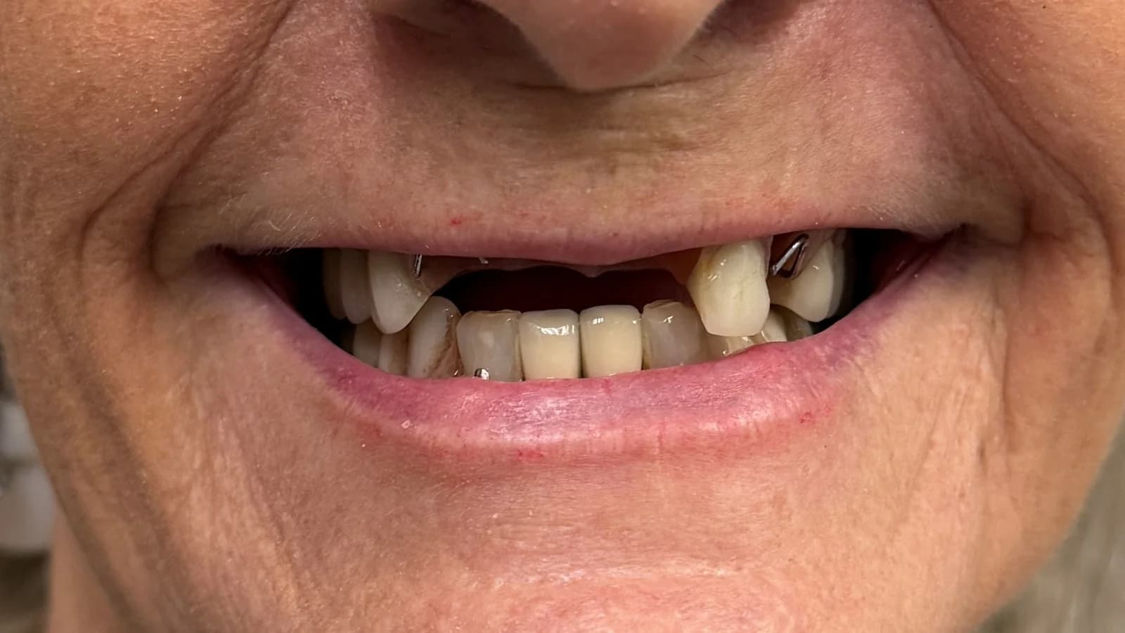 Before treatment