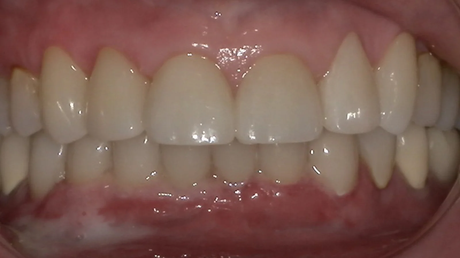 After treatment