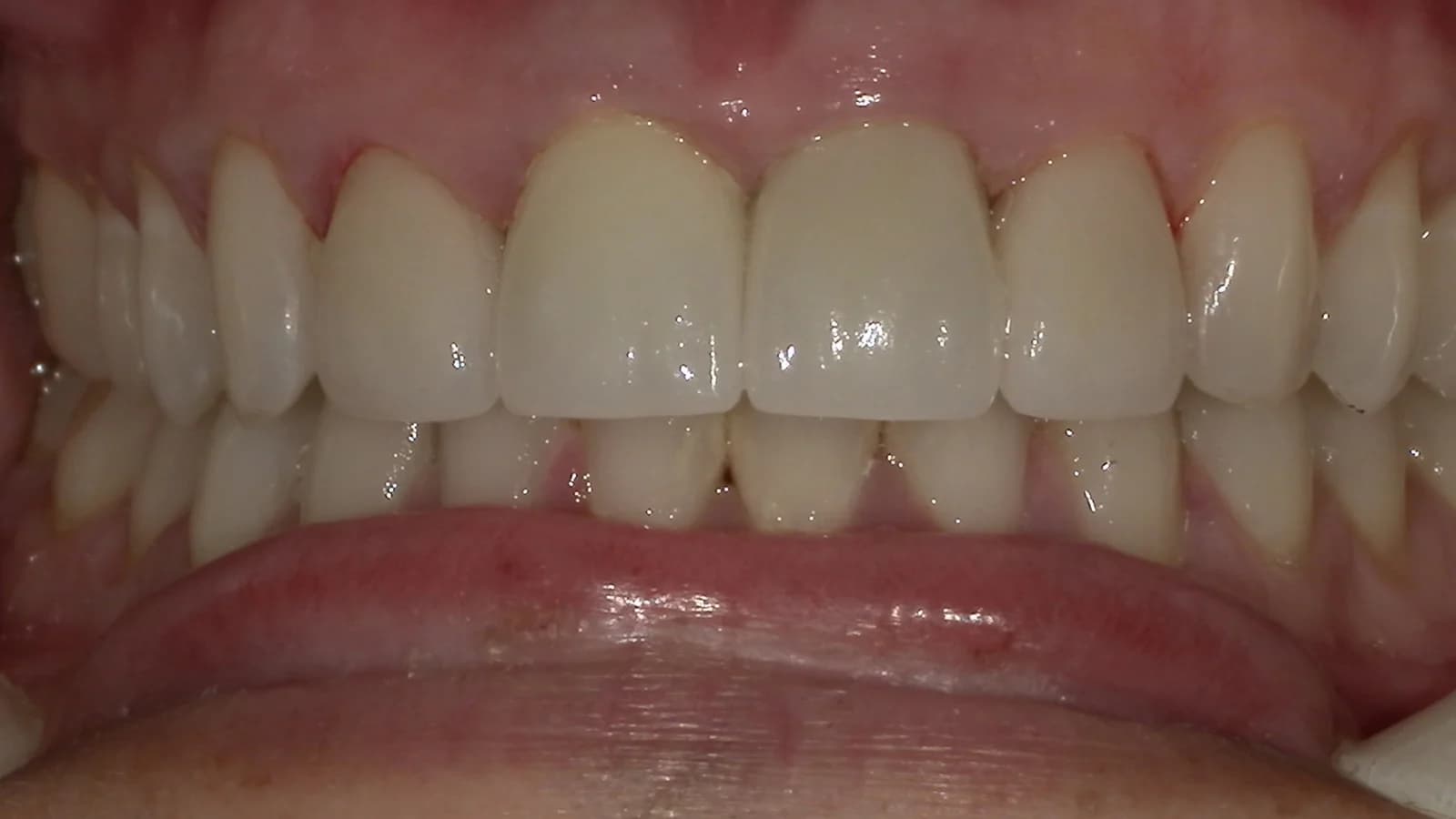 After treatment