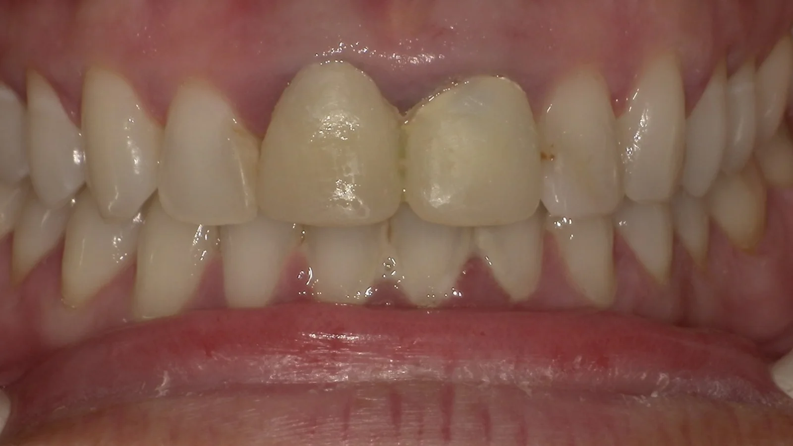 Before treatment