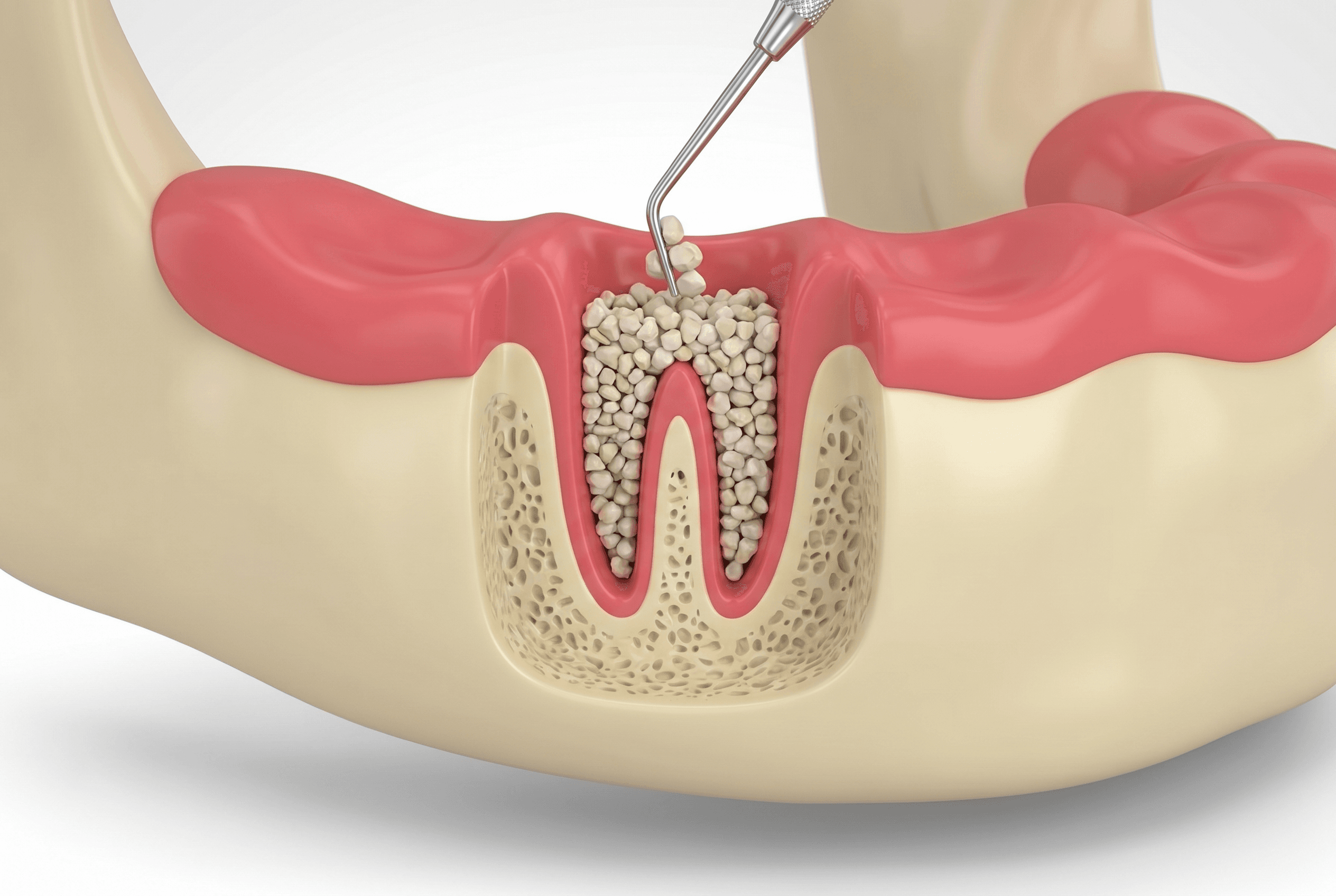 Educational illustration showing bone grafting