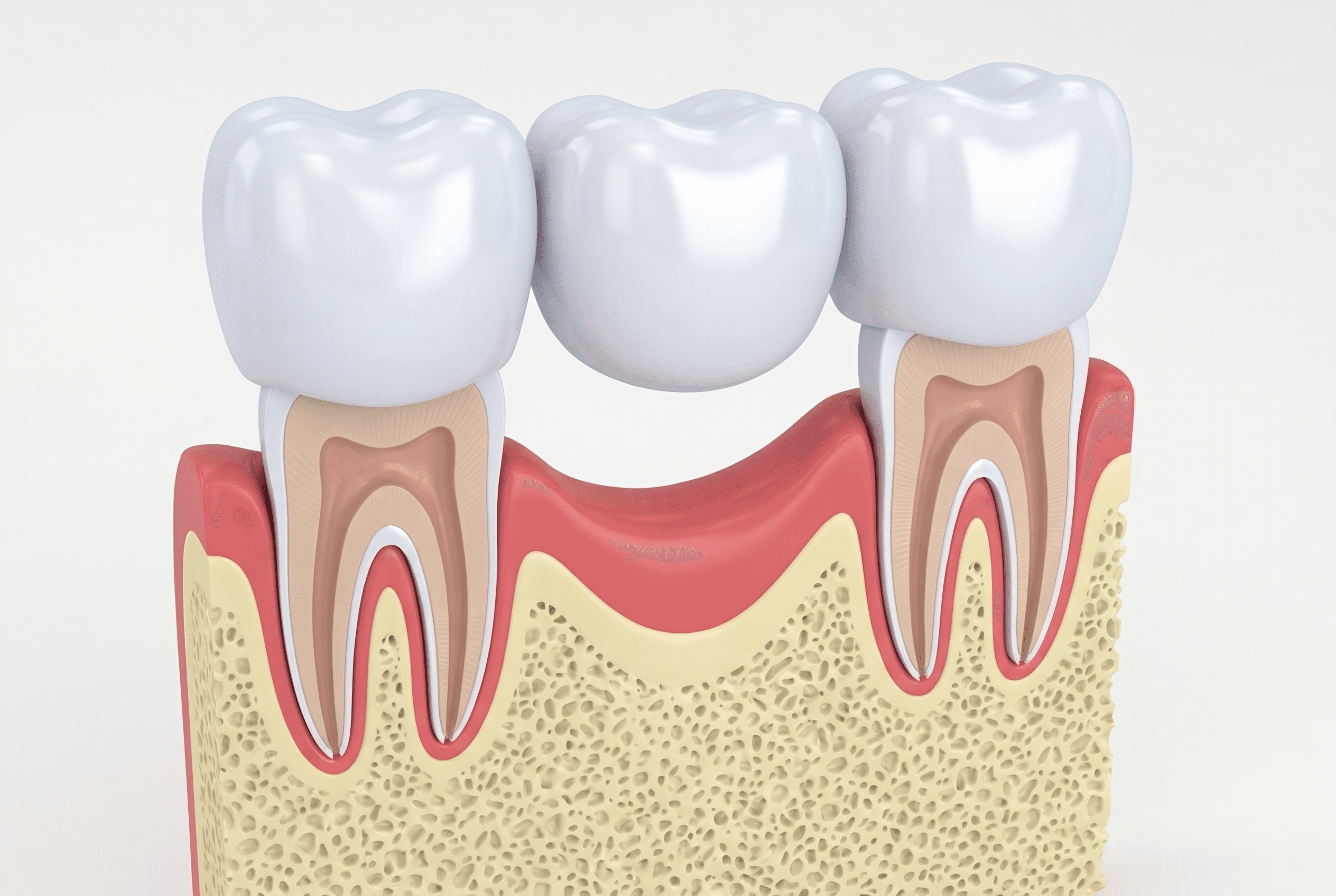 Educational illustration showing crowns & bridges