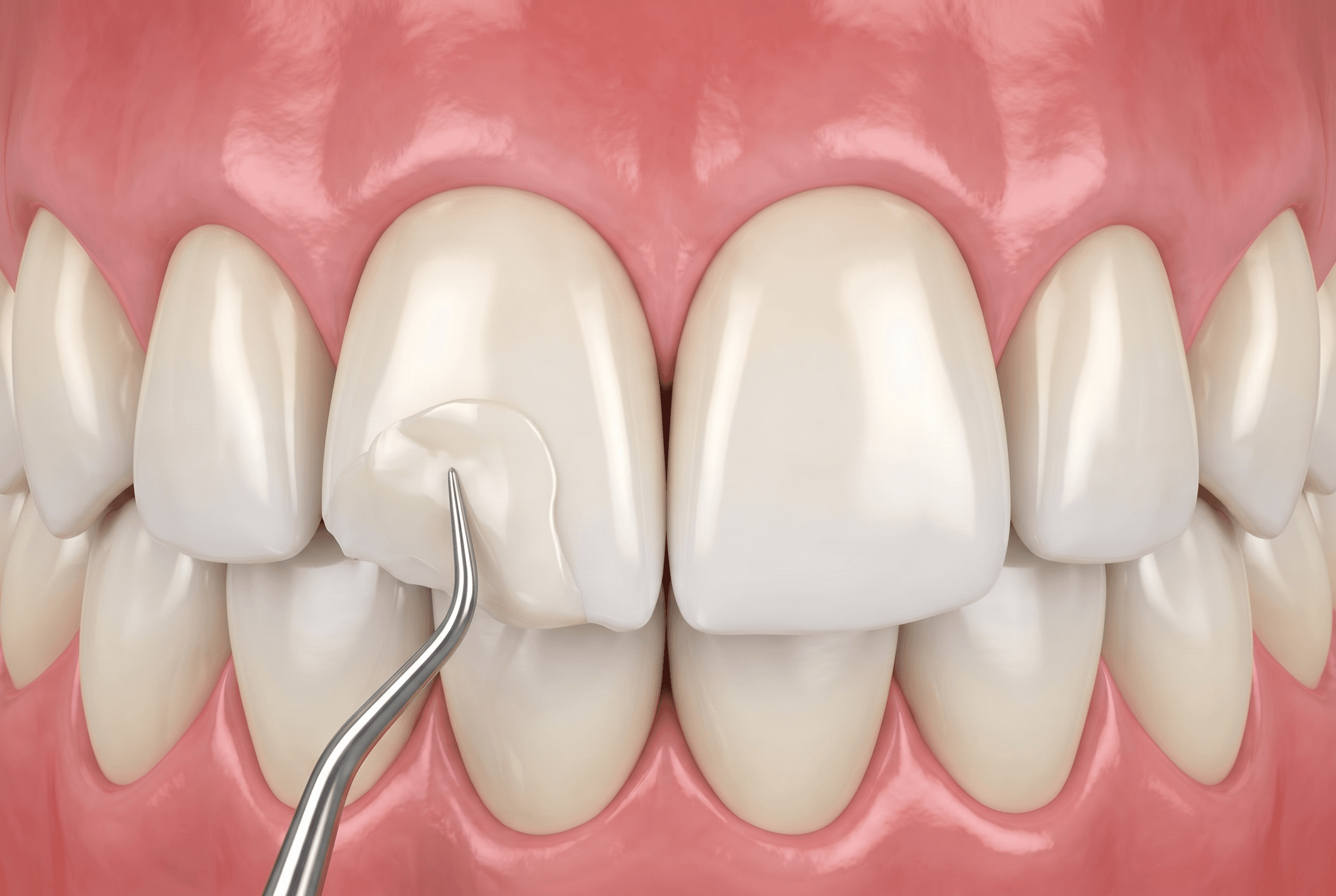 Educational illustration showing direct composite veneers