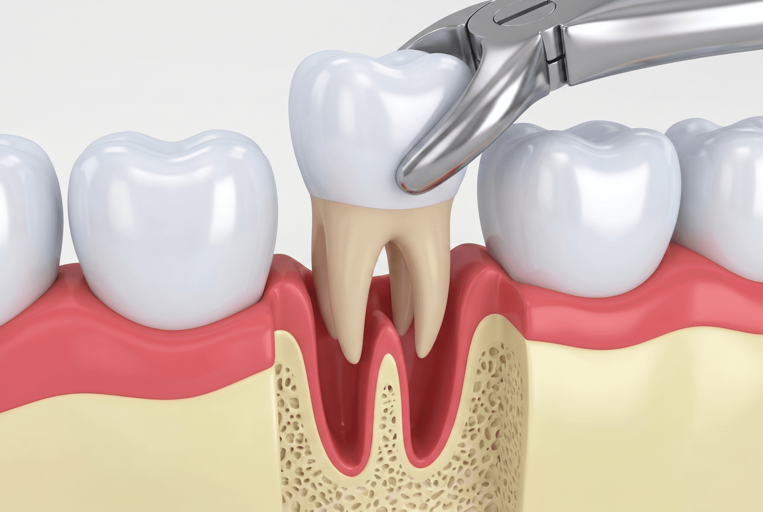 Educational illustration showing extractions