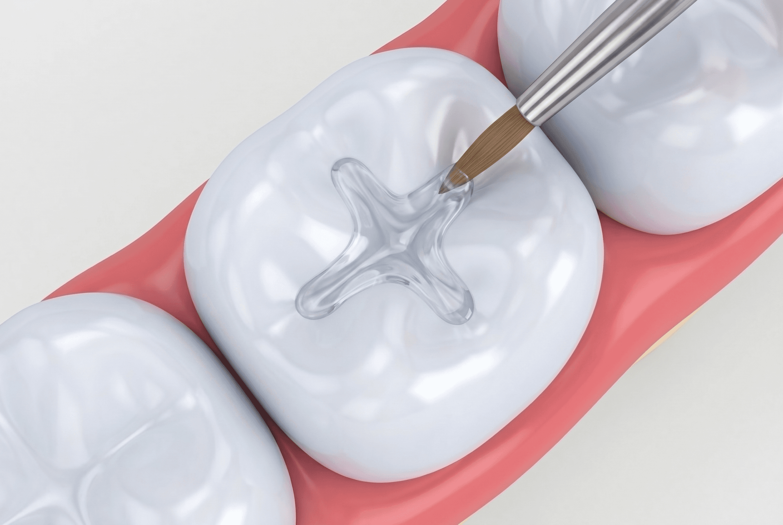 Educational illustration showing fluoride & sealants