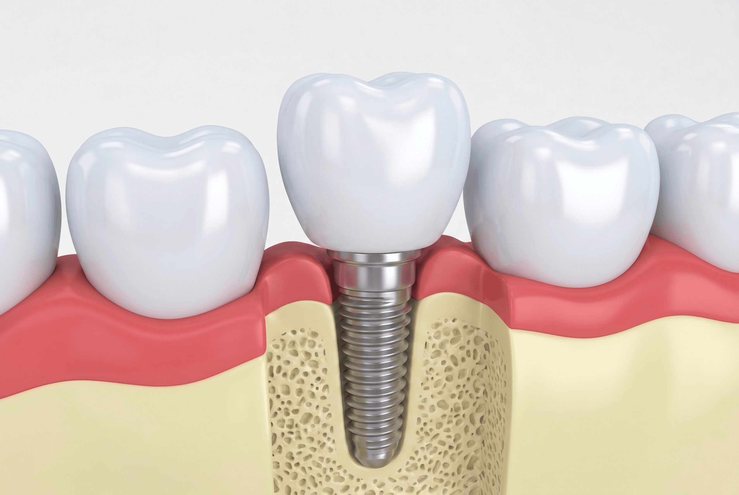 Educational illustration showing dental implants