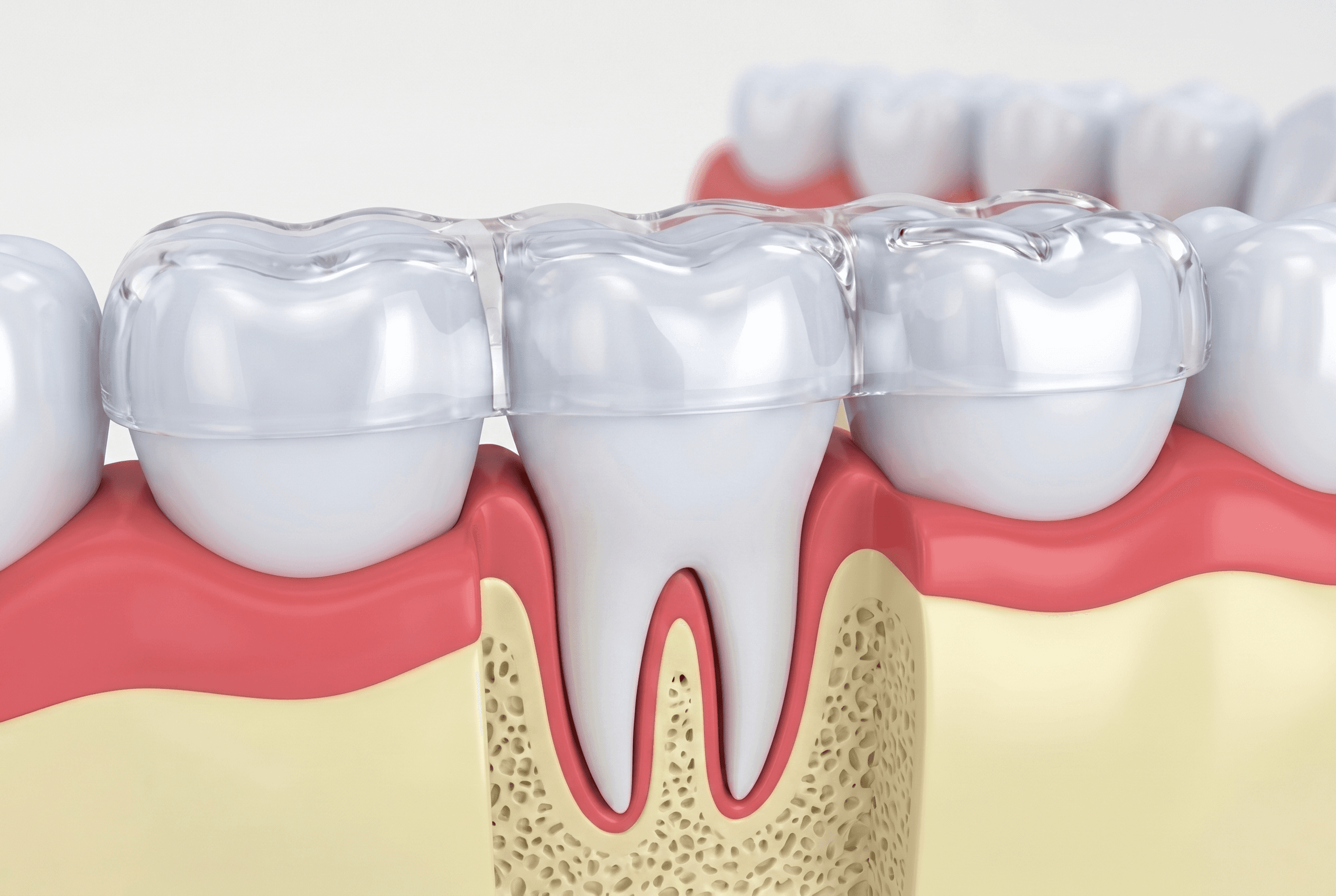 Educational illustration showing occlusal splints