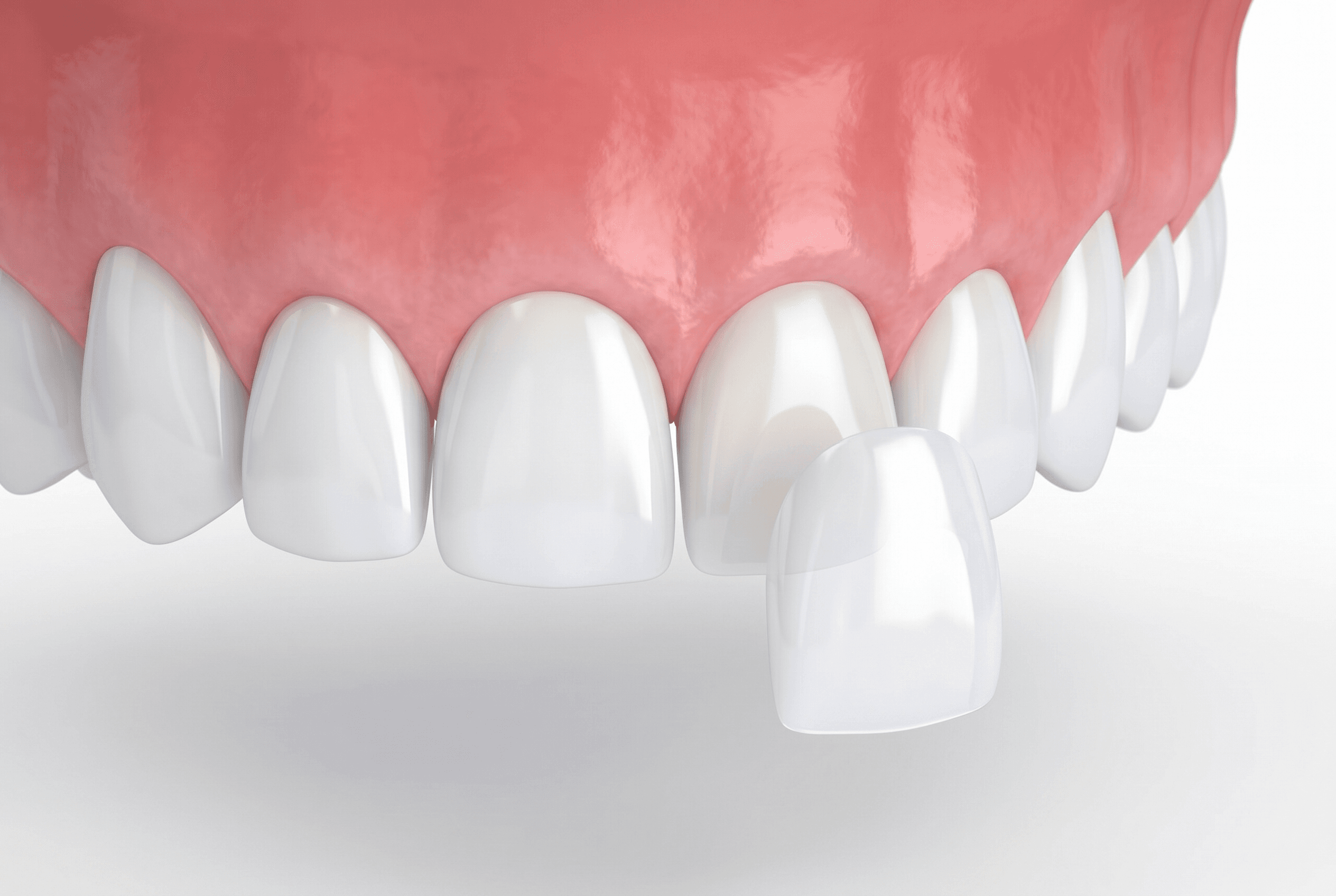 Educational illustration showing porcelain veneers