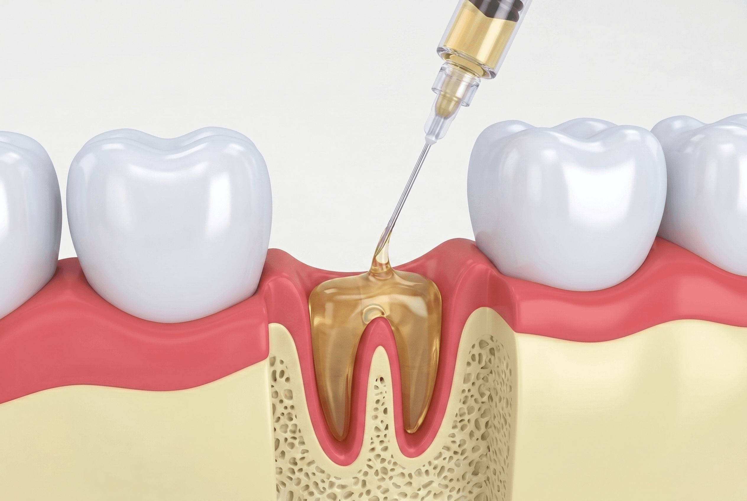 Educational illustration showing prf / prp injections