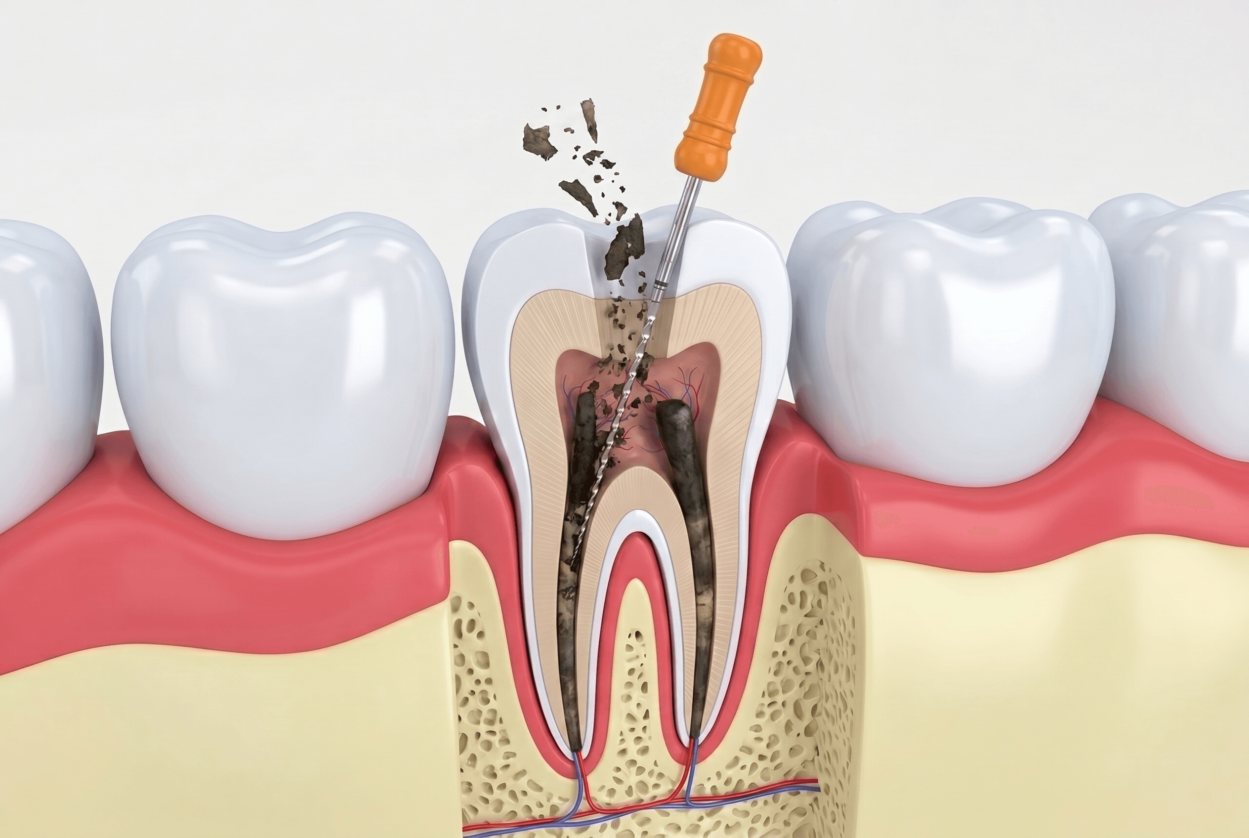 Educational illustration showing root canal retreatment