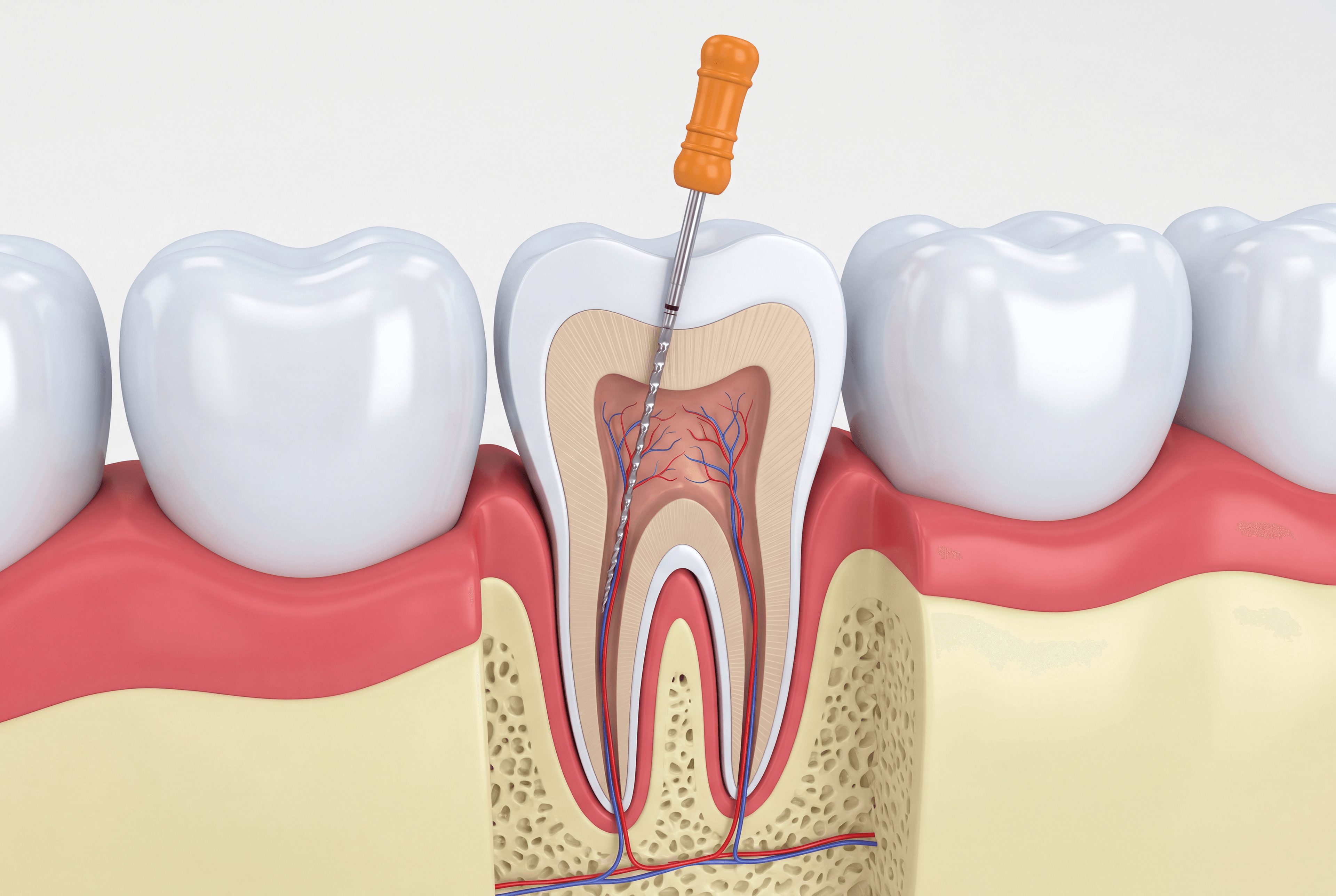 Educational illustration showing root canal therapy