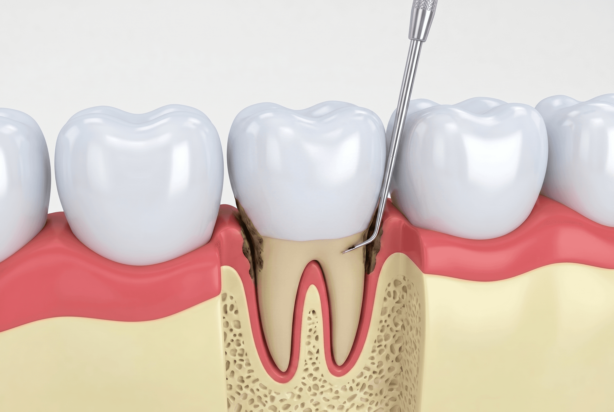 Educational illustration showing scaling & root planing